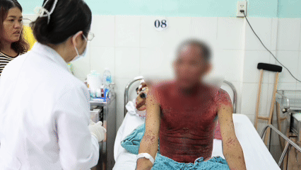 Người bệnh bị phản ứng thuốc hiếm gặp, nguy hiểm sau d&ugrave;ng thuốc nhỏ mắt